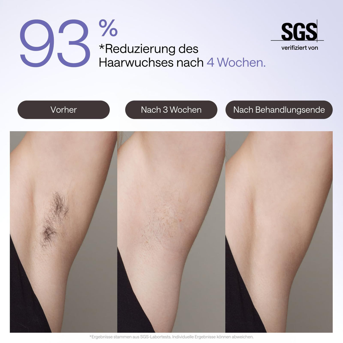 IPL-Haarentfernungsgerät für Gesicht und Körper mit Saphir-Eiskühlung, UV-Sterilisator und Aloe Vera Gel